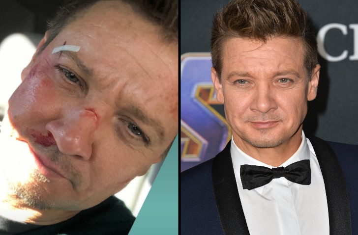 Jeremy Renner with some cuts and bruises on his face side by side with the actor at a red carpet event