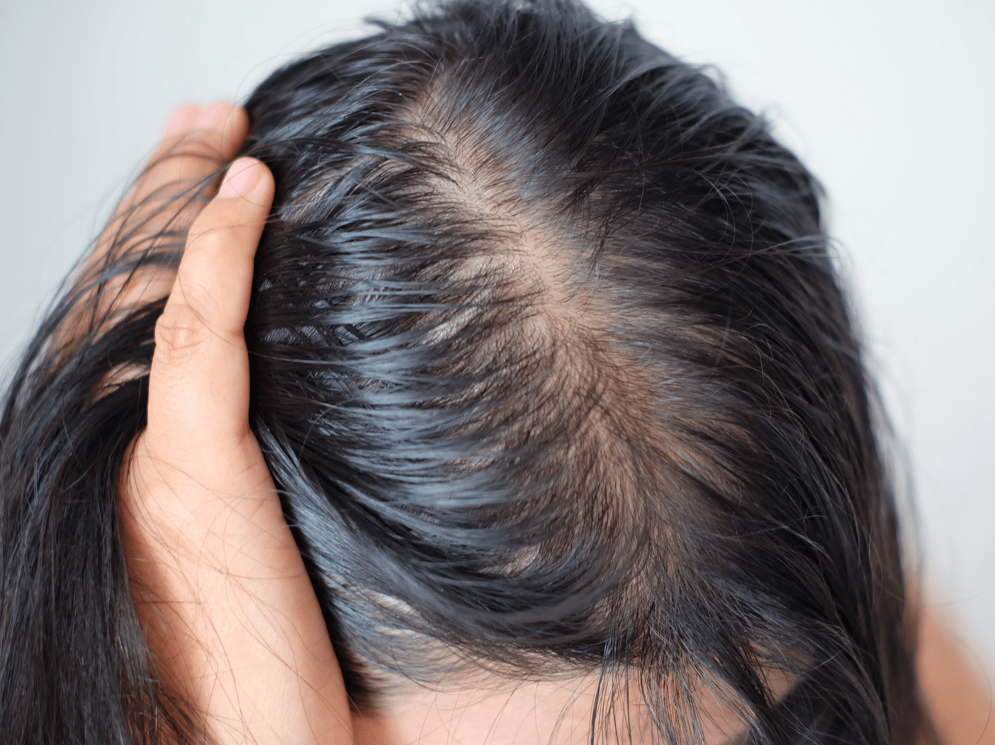 These Common Foods Are Increasing Your Risk For Thinning Hair And Hair Loss