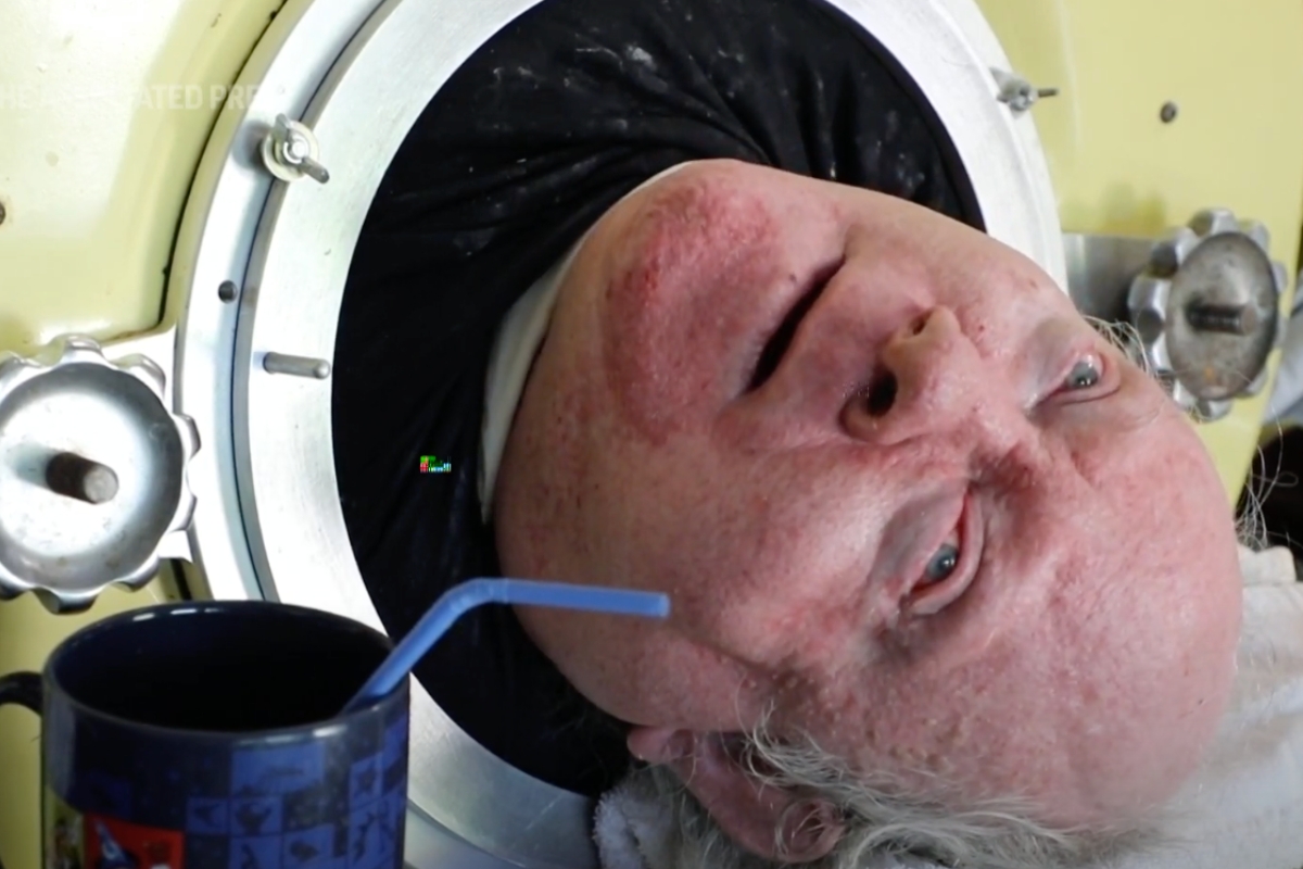 paul-alexander-polio-survivor-in-iron-lung-for-over-70-years-dies-at-78