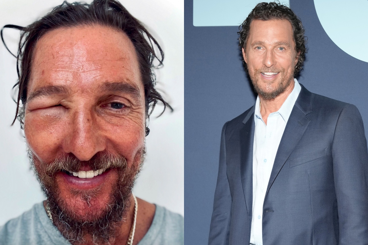 matthew-mcconaughey-horrifies-fans-with-image-of-swollen-face-after-bee-sting