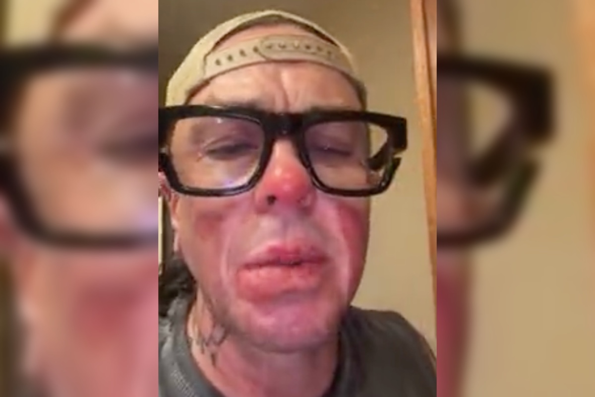 slipknots-sid-wilson-says-his-face-is-basically-melted-after-explosion-at-his-and-kelly-osbournes-farm