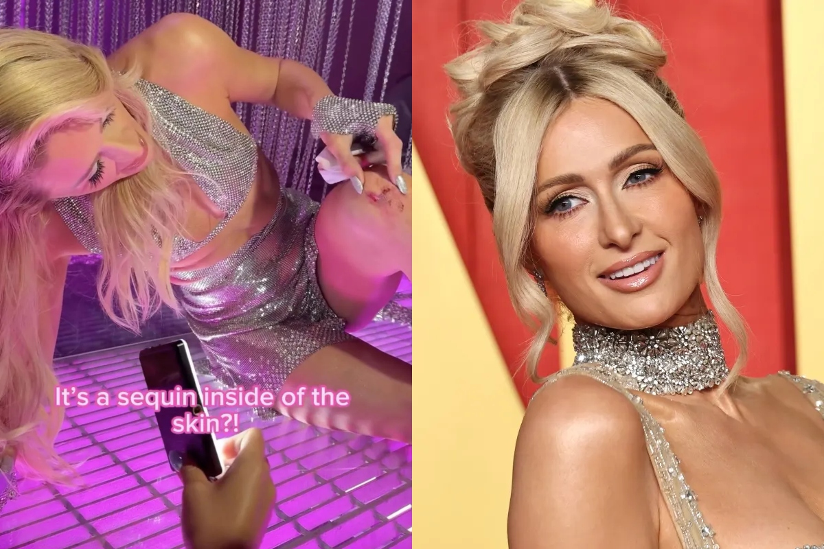 paris-hilton-injures-knee-on-music-video-set-shares-pictures-of-wound