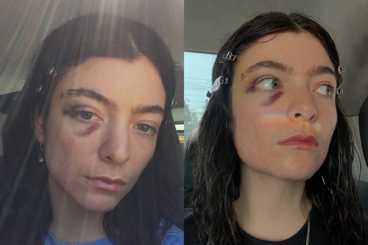 singer-lorde-horrifies-fans-with-nasty-black-eye-in-new-photos