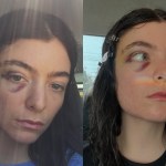 singer-lorde-horrifies-fans-with-nasty-black-eye-in-new-photos