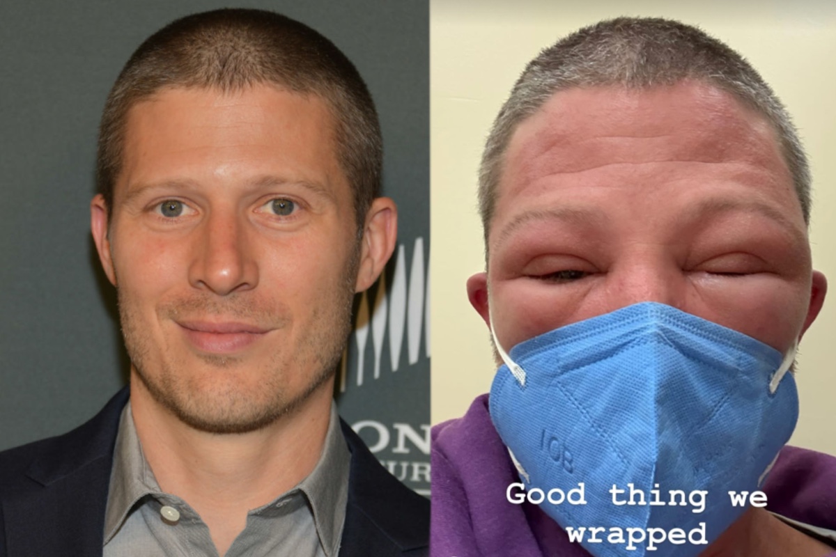 friday-night-lights-star-zach-gilford-shares-shocking-photos-of-swollen-face