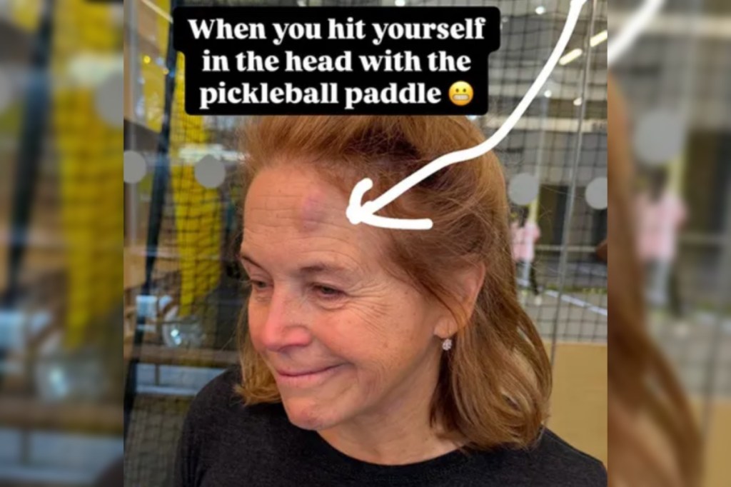 katie-couric-reveals-nasty-forehead-bruise-following-accident-in-new-photos