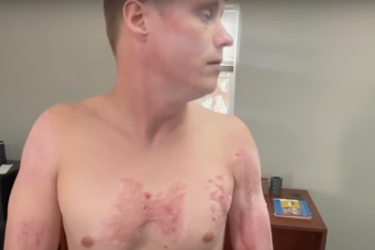 mans-attorney-claims-he-was-cooked-on-asphalt-and-suffered-third-degree-burns-when-cops-pinned-him-during-arrest